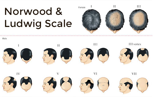 Non Surgical Hair Replacement in Kerala